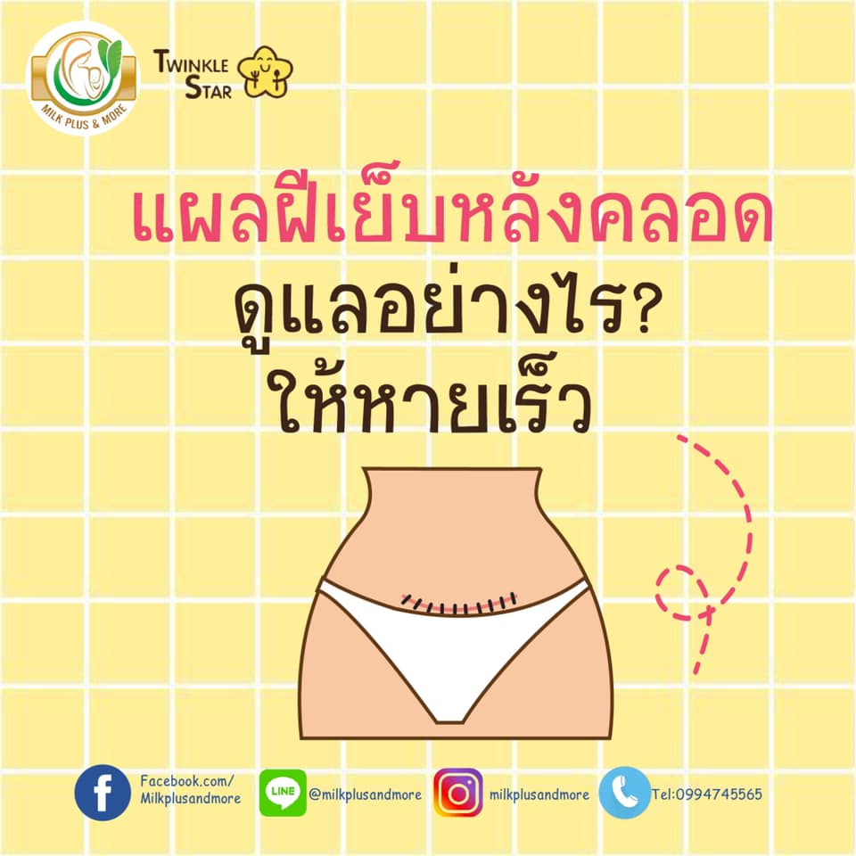 แผลฝีเย็บหลังคลอด ดูแลอย่างไรให้หายเร็ว ไม่ฉีก ไม่ติดเชื้อ